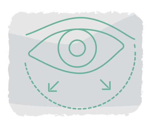 Grafische Darstellung eines Auges samt Ödem.