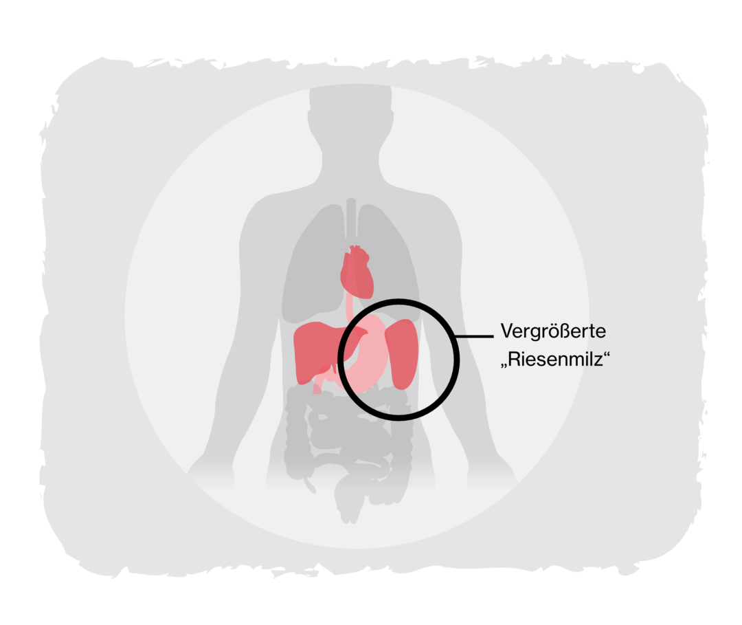 Grafik eines Menschen. Herz, Leber, Magen und Milz sind gelb dargestellt. Die vergrößerte „Riesenmilz“ ist gekennzeichnet. 