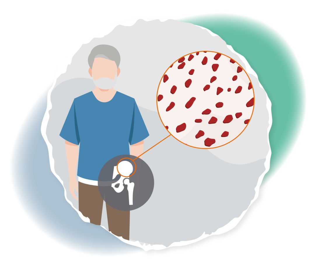 CML: Knochenmarksentnahme Schematische Darstellung eines Mannes und der Beckenschaufel. Ein Kreis kennzeichnet an der oberen Kante der Schaufel an, wo die Knochenmarkprobe entnommen wird.