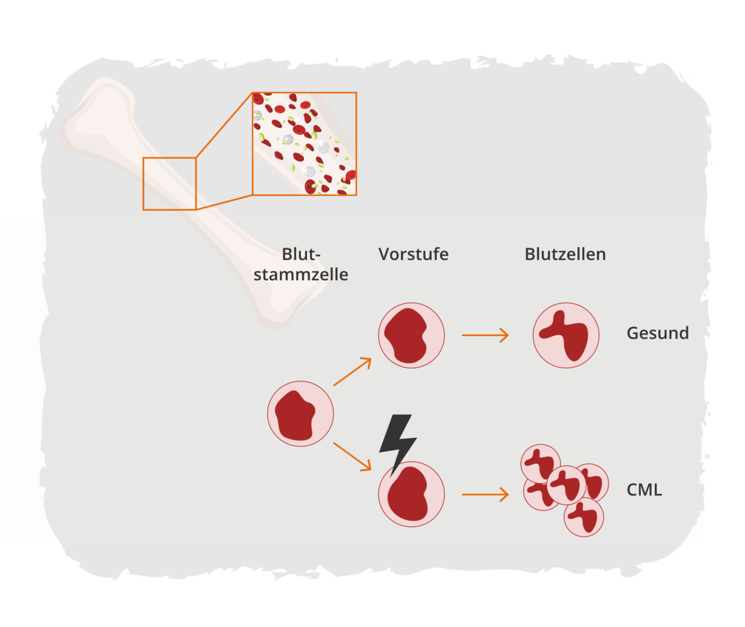 CML: Gestörte Blutbildung im Knochenmark Schematische Darstellung der Entwicklung einer Blutzelle aus einer Blutstammzelle im Knochenmark.