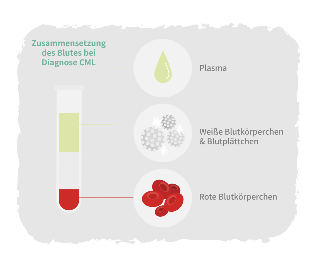 Schematische Darstellung der Blutzusammensetzung eines gesunden Menschen. Die drei wesentlichen Bestandteile sind in einem Röhrchen als Phasen nach einer Zentrifugation abgebildet: rote Blutkörperchen (rote Phase), weiße Blutkörperchen und Blutplättchen (weiße Phase) sowie das Blutplasma (gelbliche Phase). Die Phase der weißen Blutkörperchen ist breiter als beim gesunden Pendant.