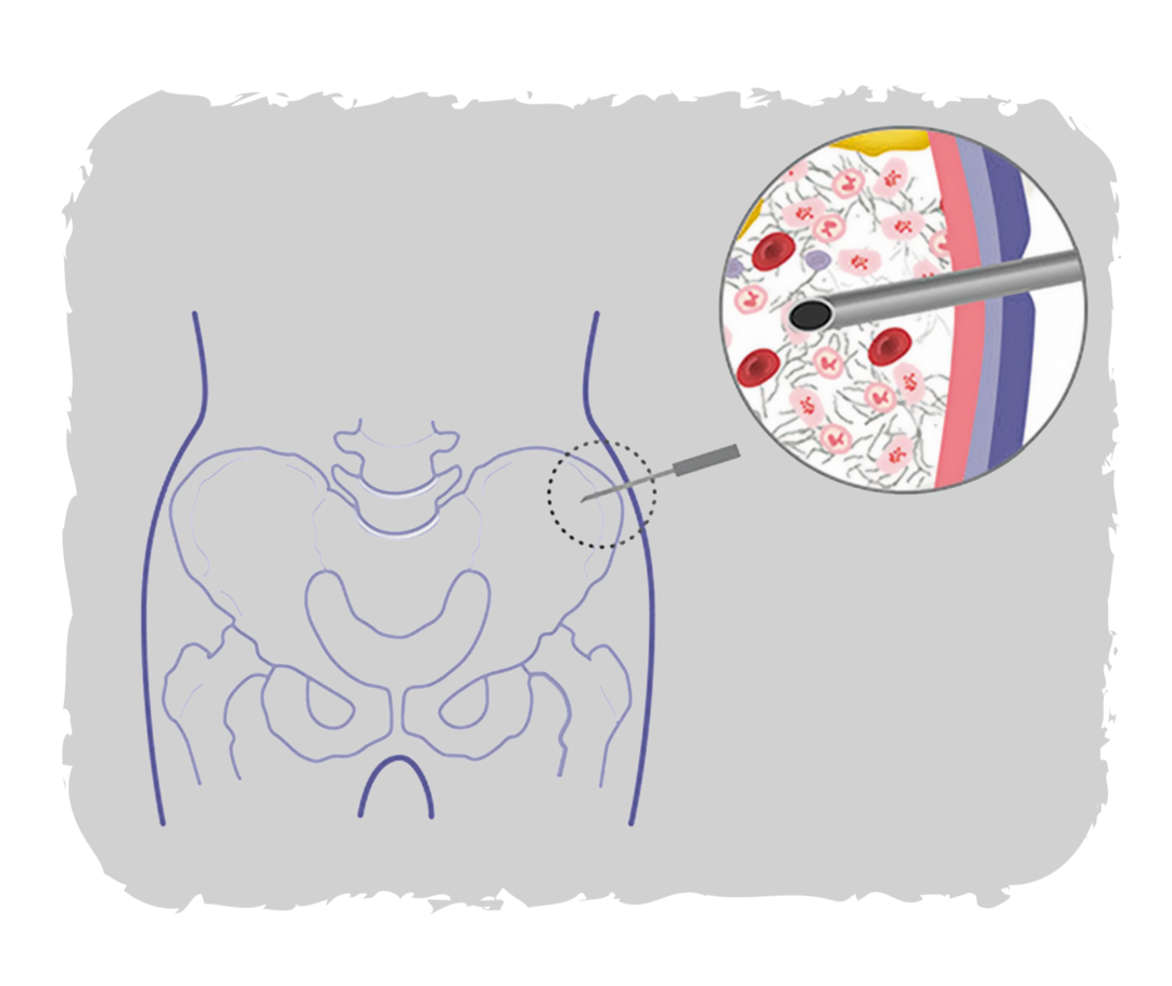 Grafik eines menschlichen Beckens, rechts ein vergrößerter Ausschnitt, in dem eine Hohlnadel sichtbar das Knochenmark punktiert. 