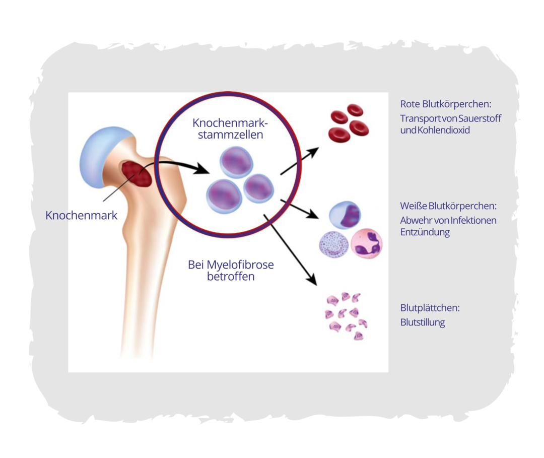 Grafik des menschlichen Oberschenkelknochens mit genauerer Darstellung der Knochenmarkzellen: rote Blutkörperchen, weiße Blutkörperchen und Blutplättchen.