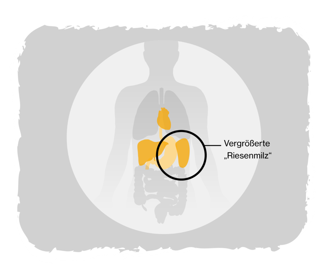 Grafik eines Menschen. Herz, Leber, Magen und Milz sind gelb dargestellt. Die vergrößerte „Riesenmilz“ ist gekennzeichnet. 