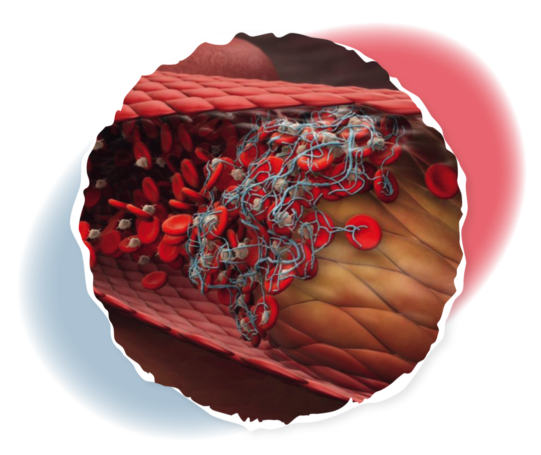 Grafik eines Blutgefäßes, in dem Blutplättchen und rote Blutkörperchen verklumpen und eine Thrombose bilden. 