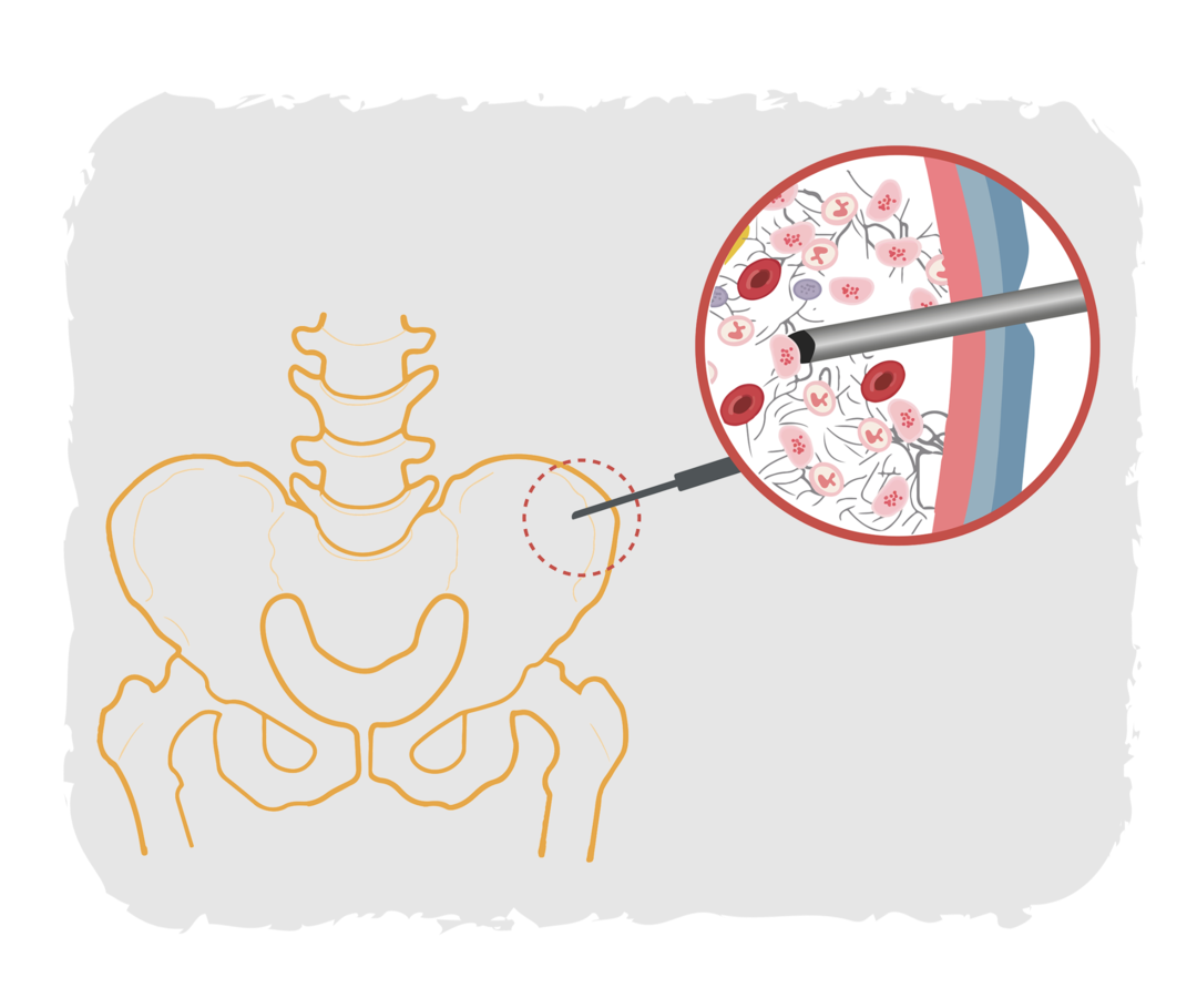 Schematische Darstellung einer menschlichen Hüfte, bei der eine Knochenmarkpunktion mit einer Nadel durchgeführt wird. 