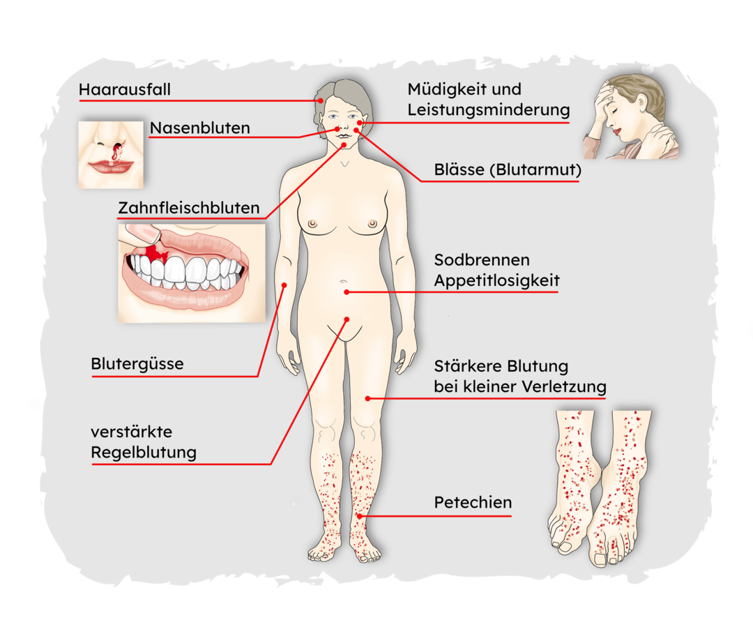 ITP: Mögliche Symptome Die Grafik zeigt eine Frau und listet verschiedene mögliche Symptome der ITP auf: Müdigkeit und Leistungsminderung, Nasenbluten, Blutergüsse, Haarausfall, Blässe (Blutarmut), Zahnfleischbluten, Sodbrennen, Appetitlosigkeit, verstärkte Regelblutung, stärkere Blutung bei kleiner Verletzung, Petechien.