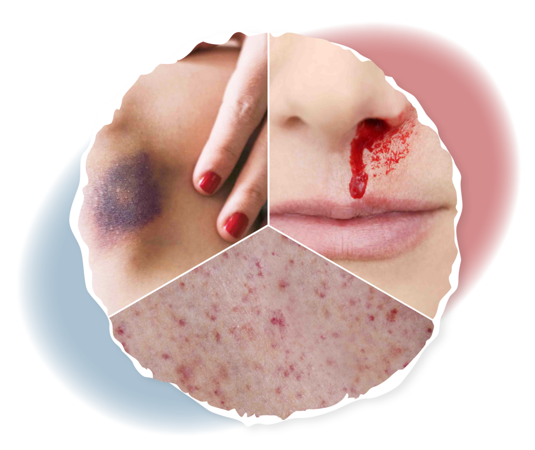 ITP: Symptome Drei Bilder nebeneinander: Links: Nahaufnahme eines blauen Flecks an einem Knie. Mitte: Nahaufnahme einer blutenden Nase. Rechts: Nahaufnahme von Petechien.