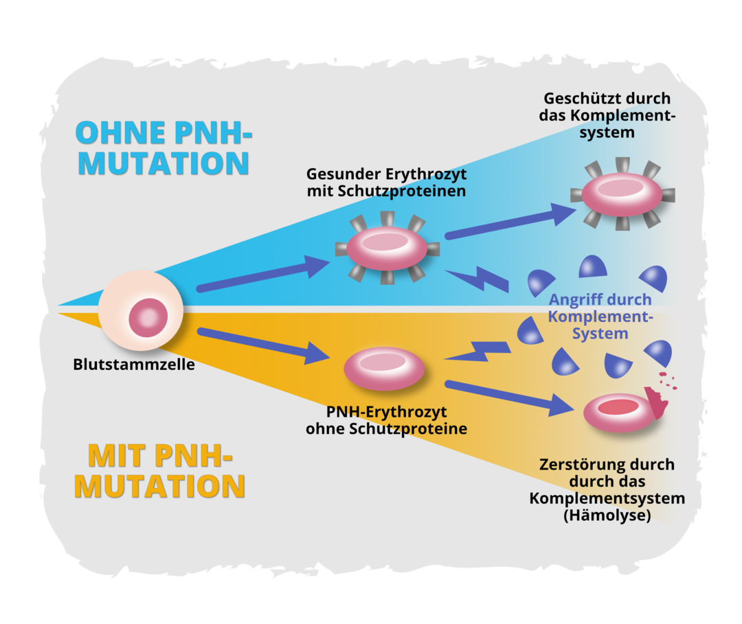 Ursachen der PNH: Angriff durch das Komplementsystem Gesunde Blutstammzellen reifen zu gesunden Erythrozyten, die Schutzproteine auf ihrer Oberfläche ausbilden. Diese Schutzproteine verhindern einen Angriff durch das Komplementsystem. Blutstammzellen mit PNH-Mutation reifen zu PNH-Erythrozyten ohne Schutzproteine auf ihrer Oberfläche. Sie sind anfällig für einen Angriff durch das Komplementsystem und werden auf diese Weise zerstört. Dieser Prozess wird als Hämolyse bezeichnet.