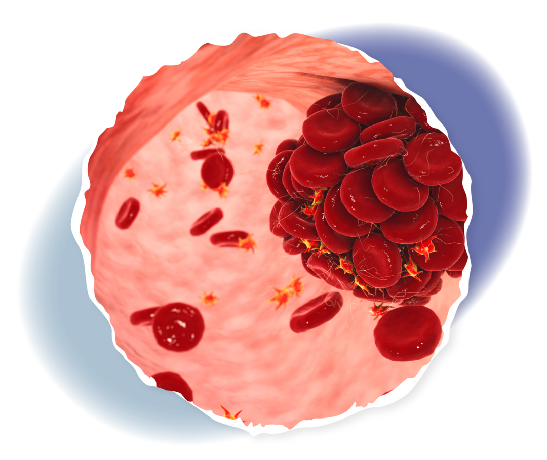 PNH: Thrombosen Grafische Darstellung des Inneren eines Blutgefäßes mit verklumpten roten Blutzellen und Blutplättchen.