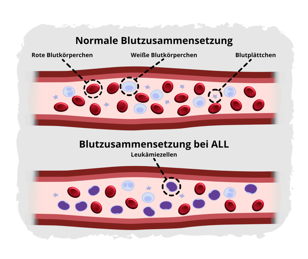 Schematische Darstellung der Blutzusammensetzung bei gesunden Menschen und bei Menschen mit einer ALL. Im Normalfall sind im Blut drei Blutzelltypen vorhanden: rote Blutkörperchen, weiße Blutkörperchen und Blutplättchen. Bei der ALL verdrängen die Leukämiezellen, entartete unreife weiße Blutkörperchen, zunehmend die gesunden Blutzellen.