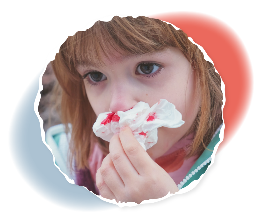 Ein junges Mädchen hält ein Taschentuch mit Blutflecken an ihre Nase.