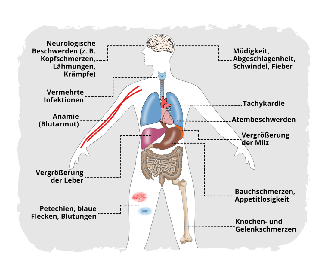 Übersicht der Symptome bei der ALL: Schematische Darstellung eines Menschen samt verschiedener innerer Organe. Um ihn herum verschiedene Symptome der ALL genannt: Neurologische Beschwerden (z. B. Kopfschmerzen, Lähmungen, Krämpfe), Müdigkeit, Abgeschlagenheit, Schwindel, Fieber, vermehrte Infektionen, Tachykardie, Anämie (Blutarmut), Atembeschwerden, Vergrößerung der Milz, Vergrößerung der Leber, Bauchschmerzen, Appetitlosigkeit, Petechien, blaue Flecken, Blutungen, Knochen- und Gelenkschmerzen