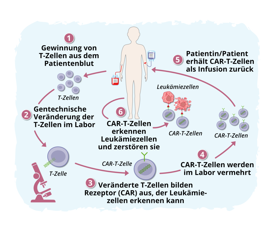 Schematische Darstellung des Ablaufs der CAR-T-Zell-Therapie: Nachdem T-Zellen aus dem Patientenblut gewonnen wurden, werden sie im Labor gentechnisch so verändert, dass sie einen bestimmten Rezeptor (CAR) ausbilden, der die Lymphomzellen erkennen kann. Die CAR-T-Zellen werden im Labor vermehrt und der Patientin oder dem Patienten als Infusion zurück verabreicht. Sie erkennen nun die Lymphomzellen und zerstören sie. 