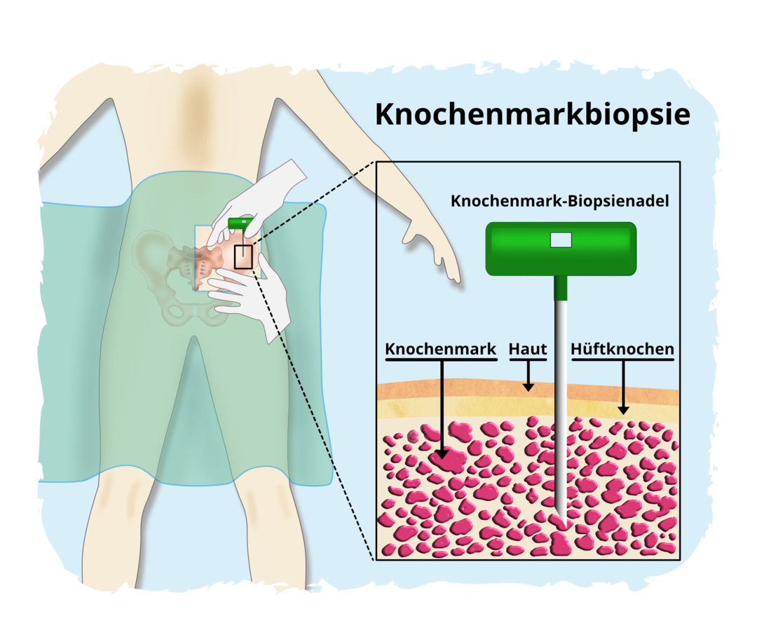 FL: Knochenmarkbiopsie Schematische Darstellung der Knochenmarkbiopsie: Eine Knochenmark-Biopsienadel wird durch Haut und Knochen bis ins Knochenmark des Beckenknochens eingeführt.