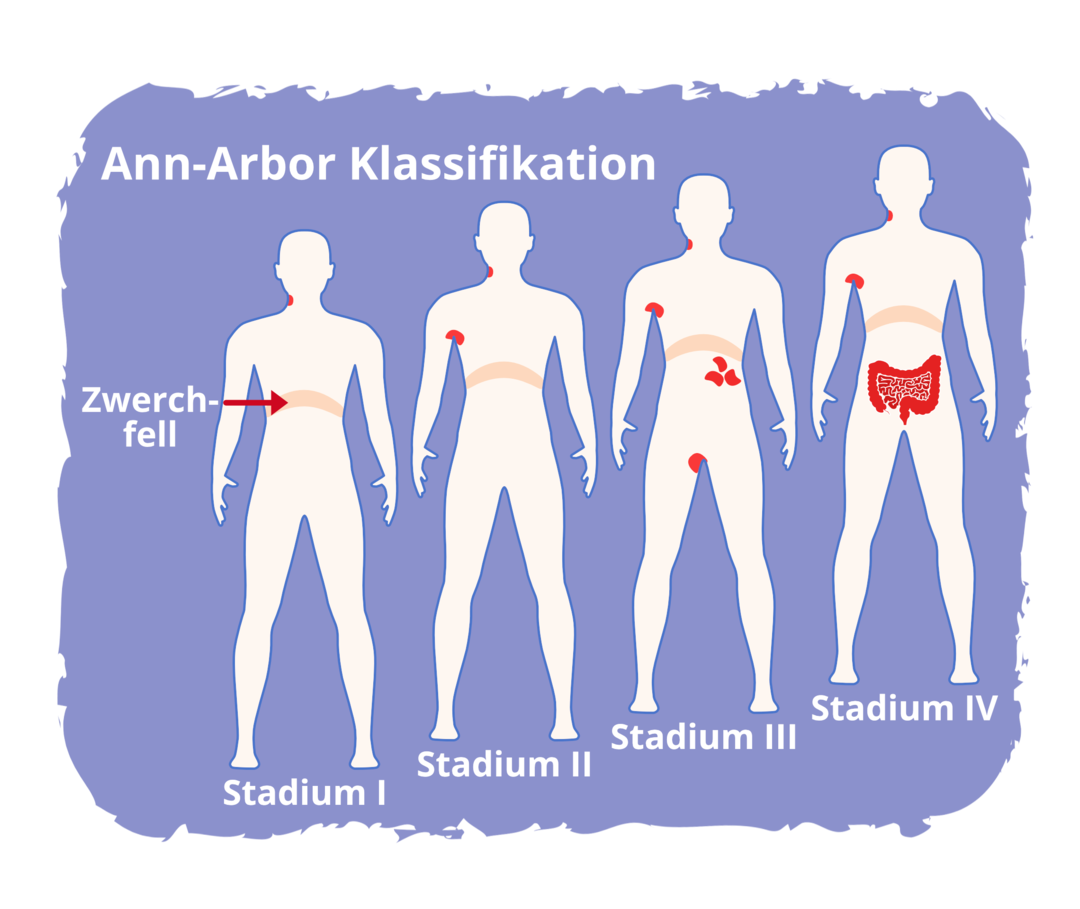 FL: Ann-Arbor Klassifikation Grafische Darstellung der vier Stadien der Ann-Arbor-Klassifikation. Ersichtlich sind vier menschliche Torsos, auf denen mit roten Punkten markiert ist, wo im Körper sich das Lymphom bereits angesiedelt hat.