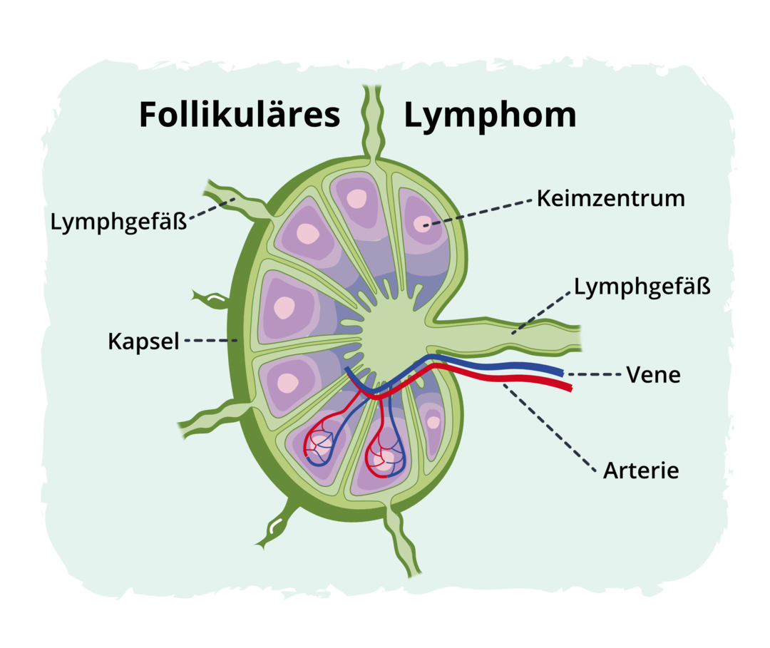 Grafische Darstellung eines Lymphknotens mit Kennzeichnung der Lymphgefäße, der versorgenden Arterie und Vene sowie der umgebenden Kapsel. Gekennzeichnet ist außerdem das Keimzentrum. 