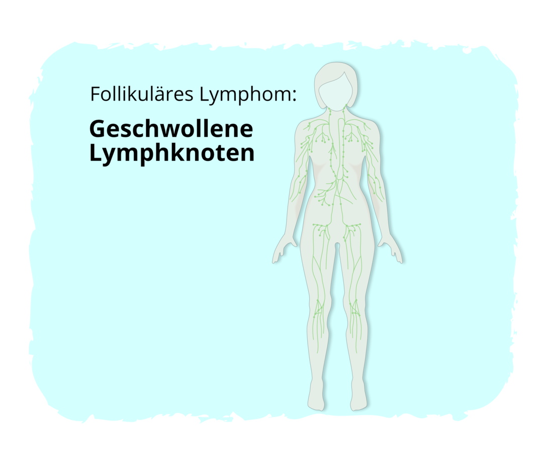 Follikuläres Lymphom: Geschwollene Lymphknoten Grafische Darstellung eines menschlichen Körpers mit Hervorhebung der Lymphgefäße und Lymphknotenstationen in Grün.