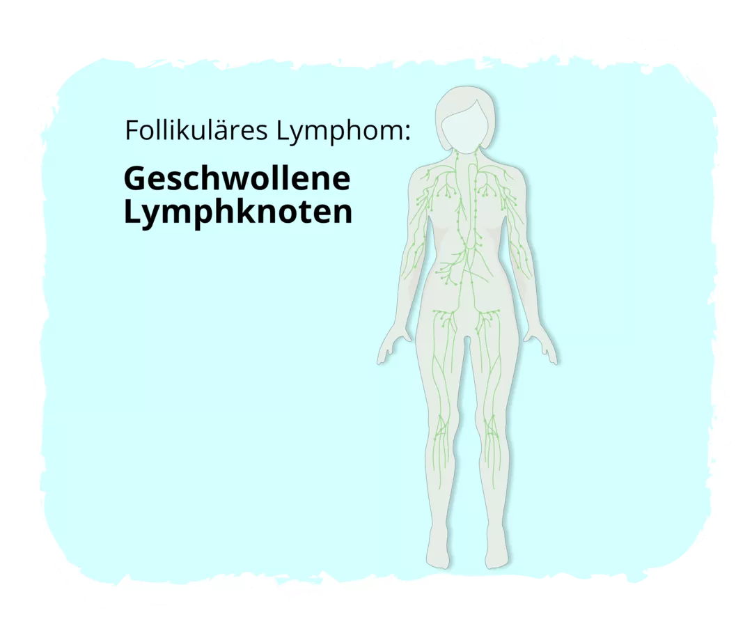 Grafische Darstellung eines menschlichen Körpers mit Hervorhebung der Lymphgefäße und Lymphknotenstationen in Grün. 