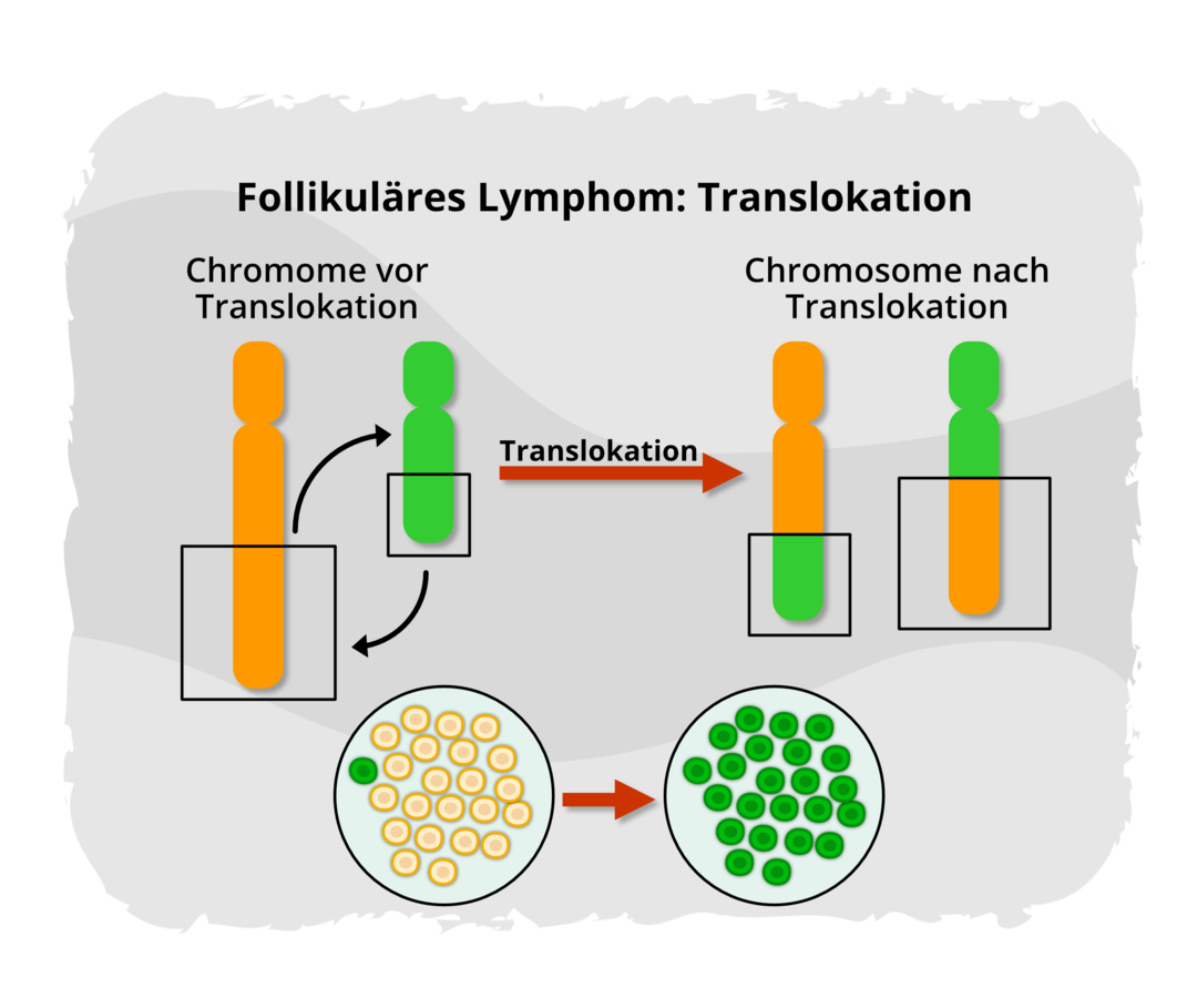 Grafische Darstellung zweier Chromosomen, die Genabschnitte untereinander austauschen. Zwei voneinander entfernte Gene kommen deshalb direkt nebeneinander zu liegen. Dadurch wird das Bcl-2-Gen überaktiv.  